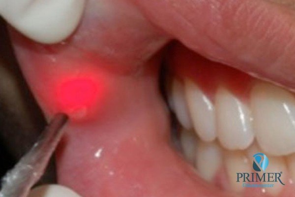 Laserterapia Primer Odontocenter Aparador Com Espelho ~ Laserterapia Primer Odontocenter